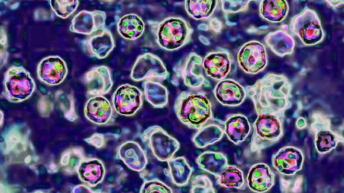 Unvaccinated PA Woman Dies of Measles in 2026 Outbreak
